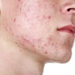 15 home treatments for pimples 1